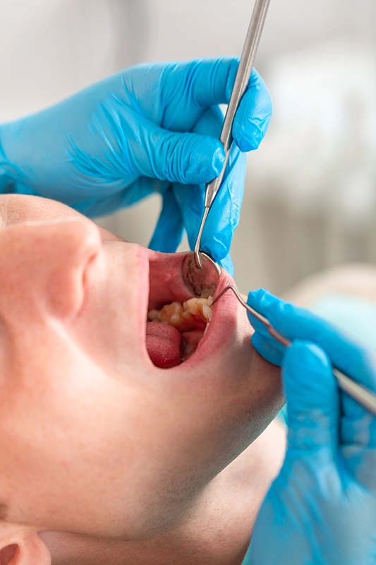 Periodontal (Gum) disease​